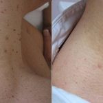 A before and after picture of the skin on someone 's back.