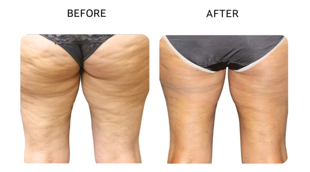 venus bliss max before and after1