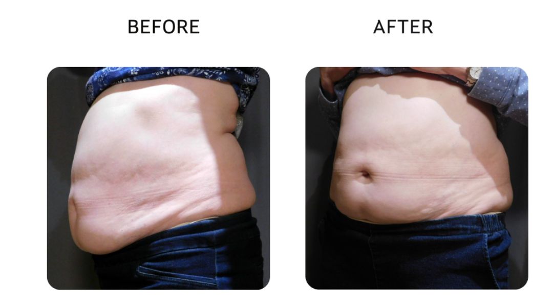 venus bliss max before and after10