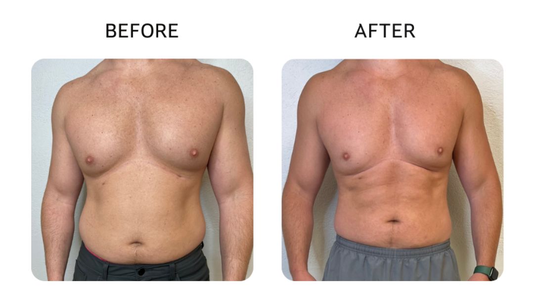 venus bliss max before and after11