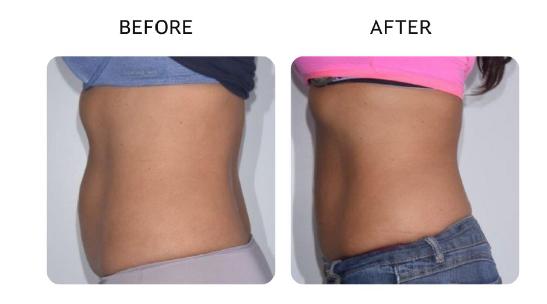 venus bliss max before and after3