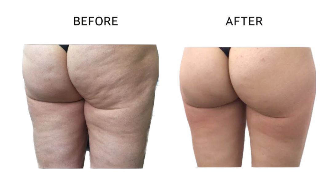 venus bliss max before and after4