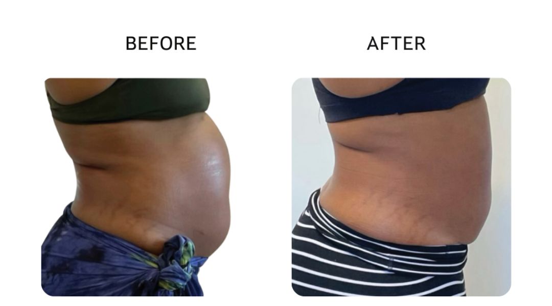 venus bliss max before and after6
