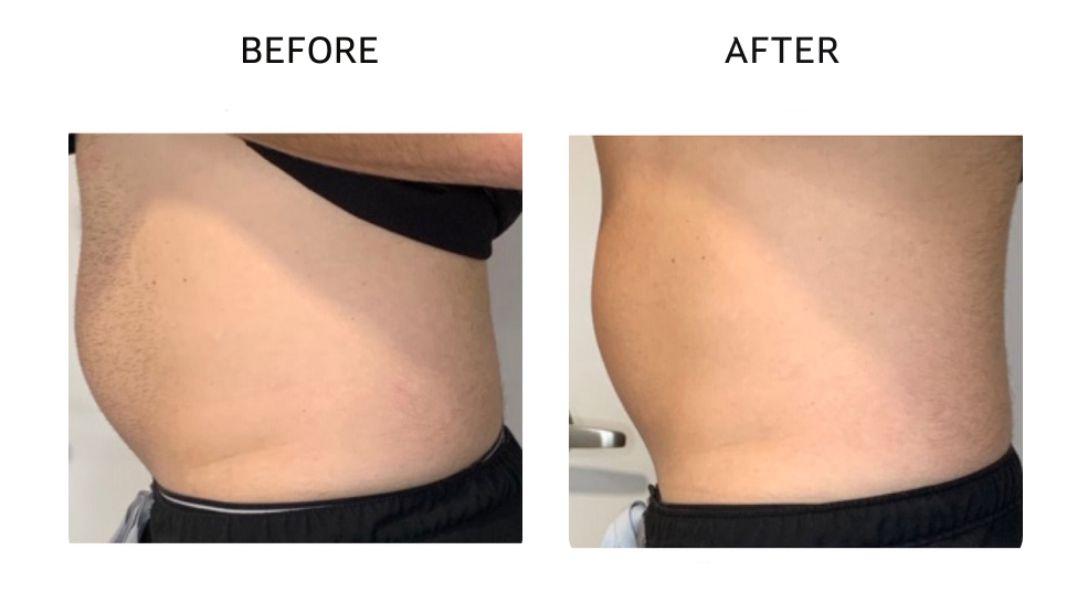 venus bliss max before and after7