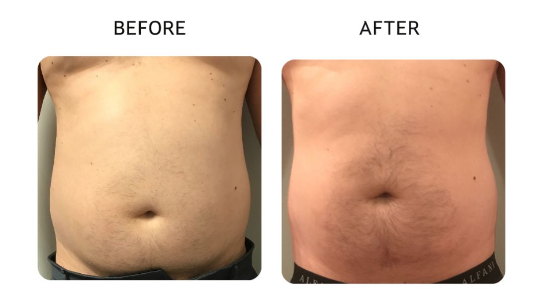 venus bliss max before and after8