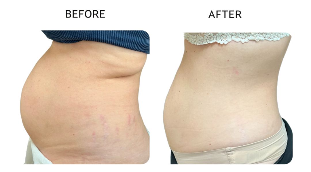 venus bliss max before and after9