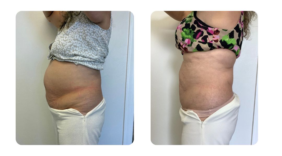 Venus Bliss Max before and after