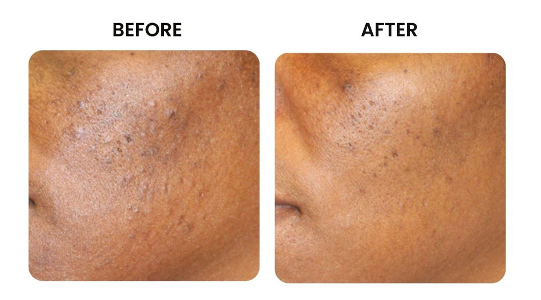 before and after facial rejuvenation1