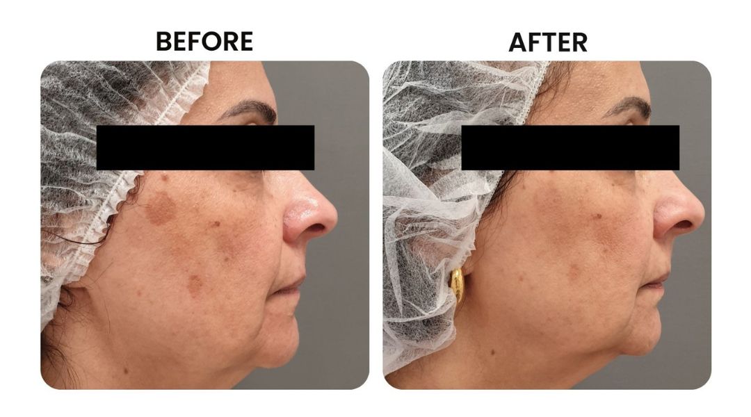 before and after facial rejuvenation10