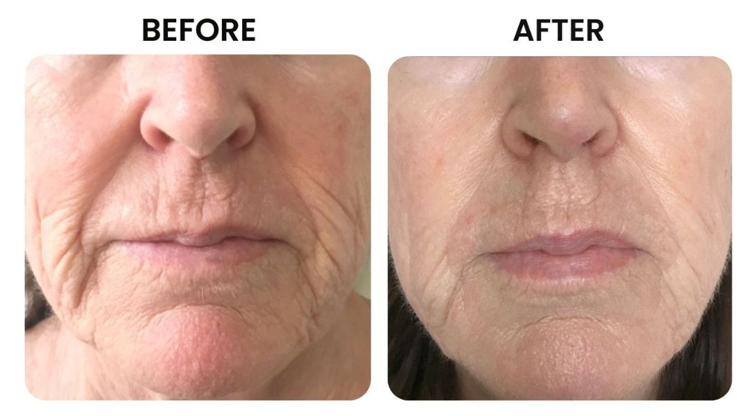 before and after facial rejuvenation11