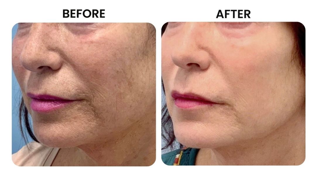 before and after facial rejuvenation12
