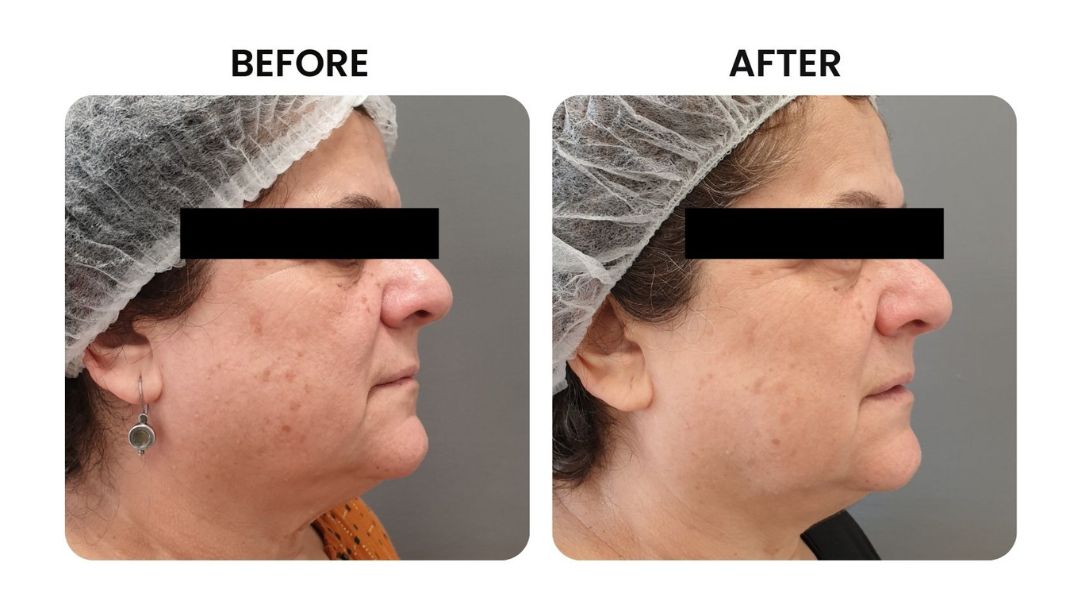 before and after facial rejuvenation13