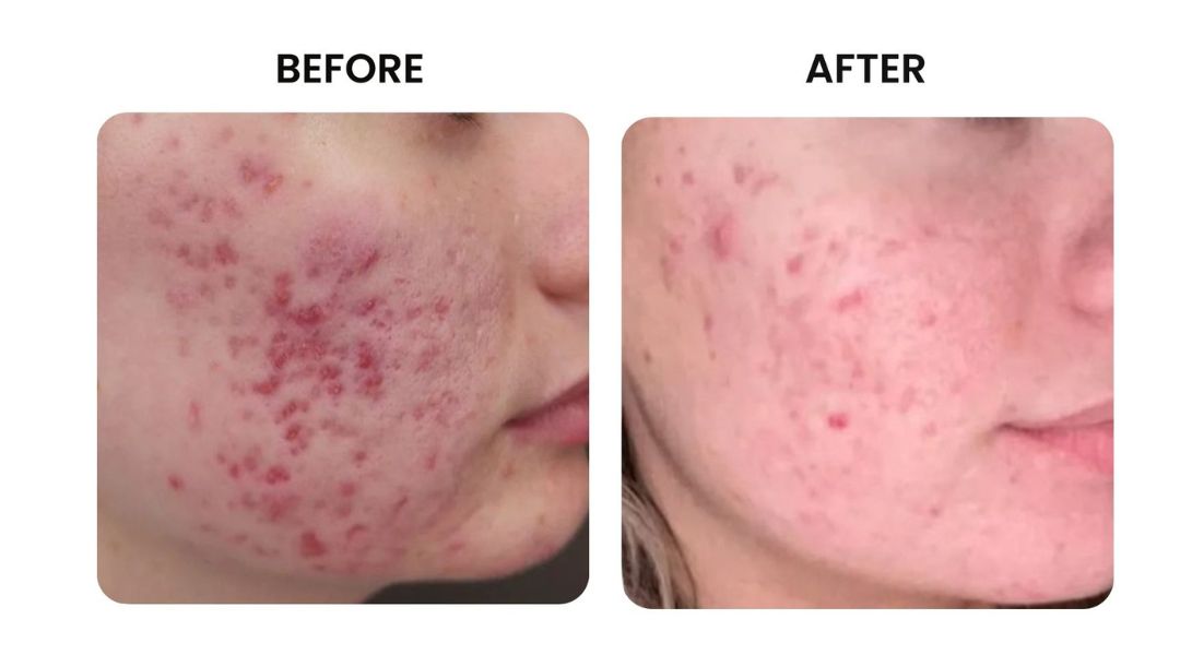 before and after facial rejuvenation2