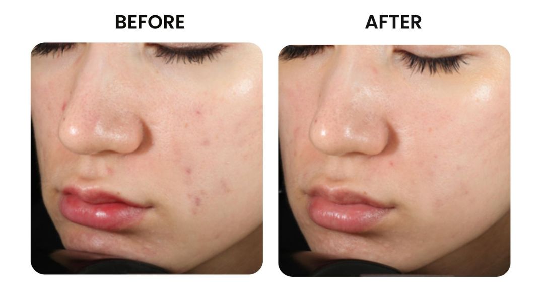 before and after facial rejuvenation3