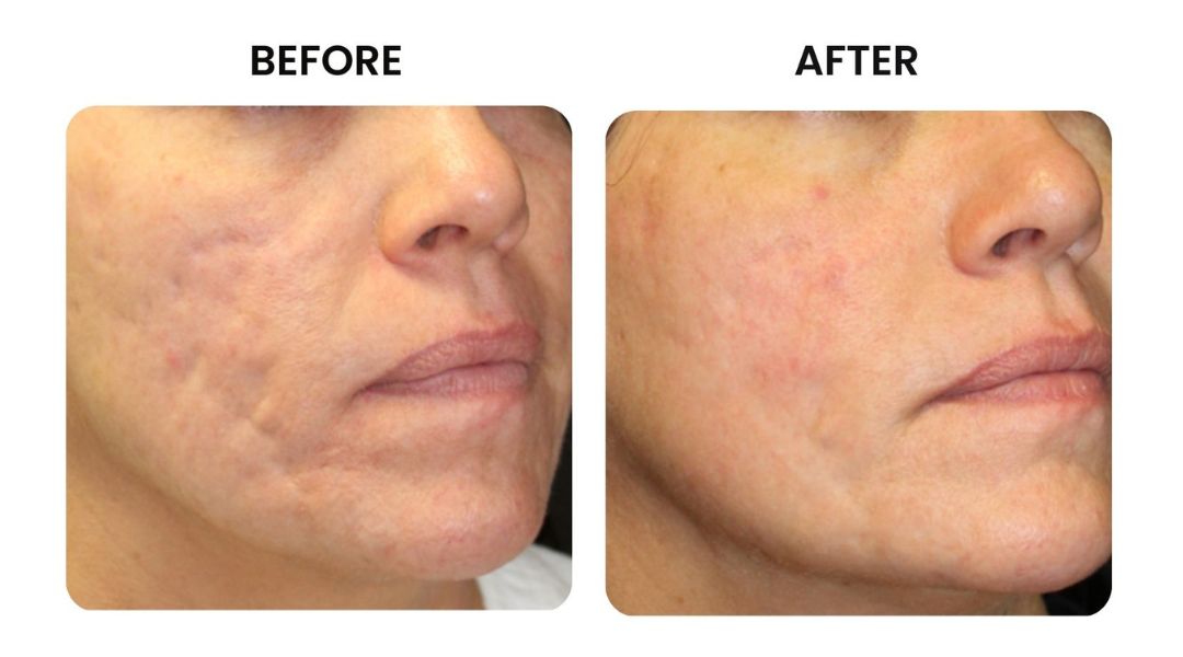 before and after facial rejuvenation4