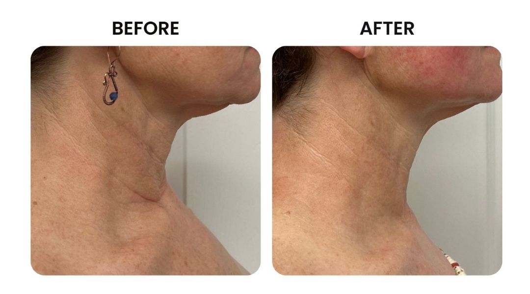 before and after facial rejuvenation5