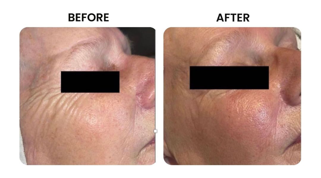 before and after facial rejuvenation6