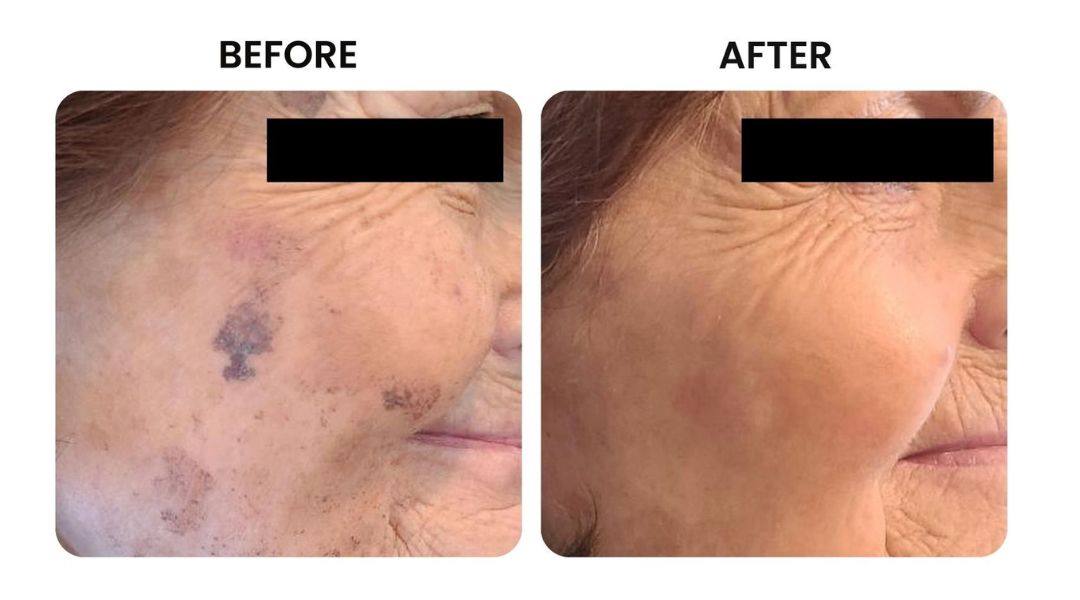 before and after facial rejuvenation7