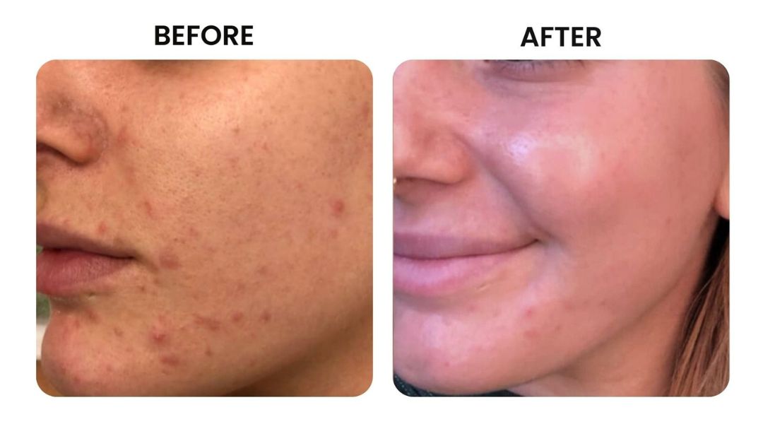 before and after facial rejuvenation8