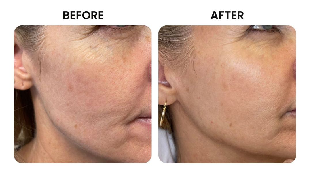 before and after facial rejuvenation9